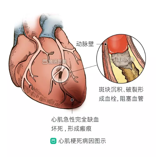 高血压不吃药,他凌晨起来胸痛难忍,没想到