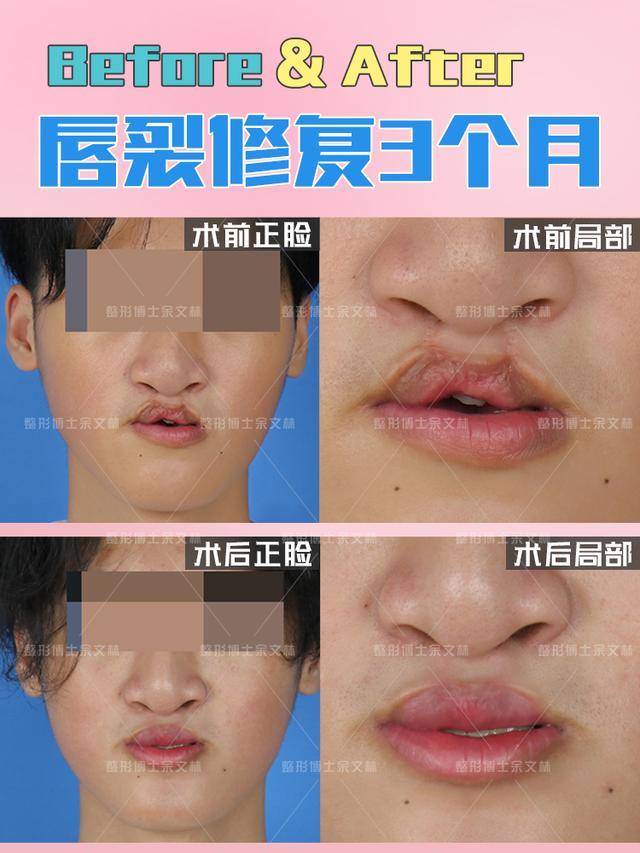 例如我们这为求美者,术前由于一期手术的疤痕,嘴巴无法完全闭合.