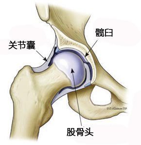 髋关节滑膜炎的症状髋关节滑膜炎要注意什么