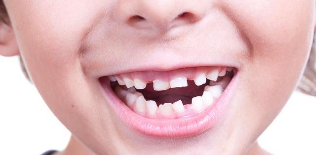 据说,标准笑容是露出8颗牙齿,可宝宝笑得露出牙龈怎么