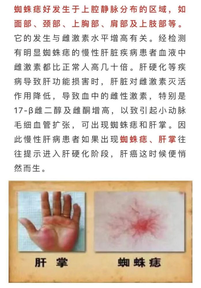 脖子上长了小红痣,去医院检查后发现得了肝癌,这些症状要注意_腾讯