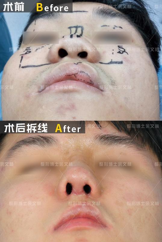 怎么判断唇裂鼻畸形矫正是否成功?余文林解答