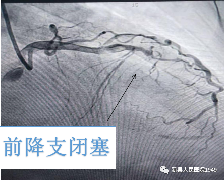 新县人民医院成功实施首例pci急诊冠状动脉造影及支架植入术手术