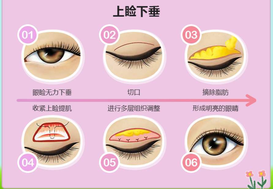 99的人都被忽悠了割双眼皮要做上睑提肌
