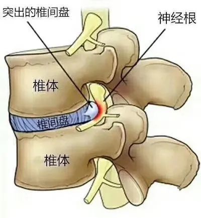 腰椎间盘突出|腰椎间盘|椎间盘|坐骨神经痛|腰椎间盘突出症