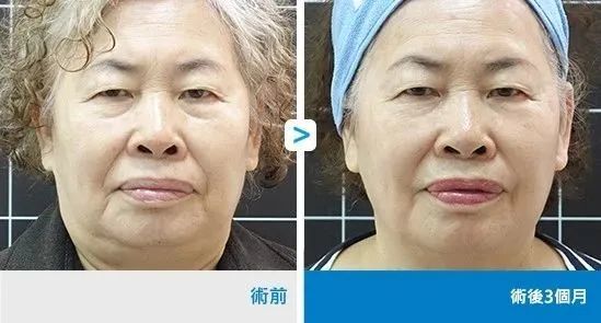 科技抗衰7d聚拉提2021业绩
