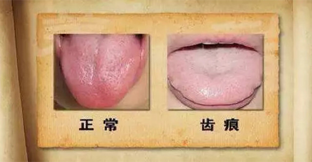 珍贵舌诊脾胃虚寒胃阴不足气滞血瘀的舌苔看完记得存