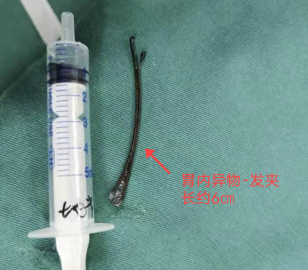 3岁男孩误吞6厘米发夹,医生行胃镜下胃腔异物取出术取出