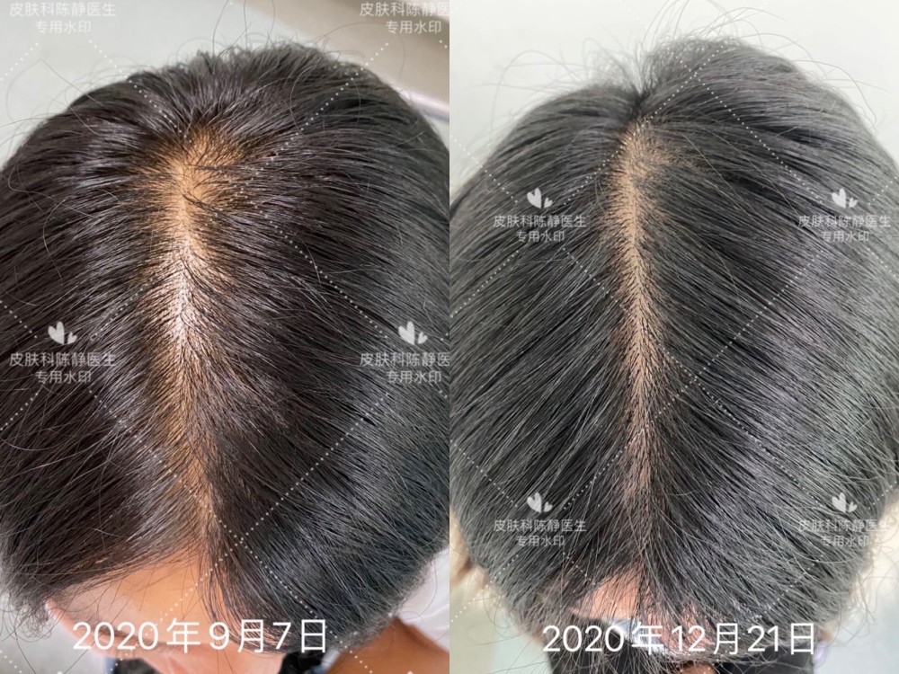 如图是女性雄激素性脱发治疗三月余,鬓角头发密度增加,发缝变窄,随访