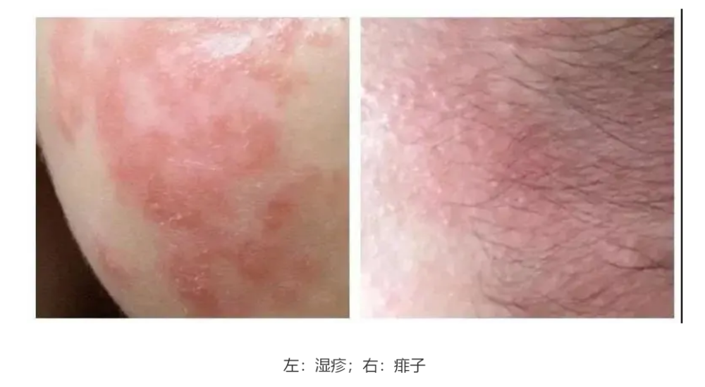 SEO十万个为什么会长湿疹 腾讯网