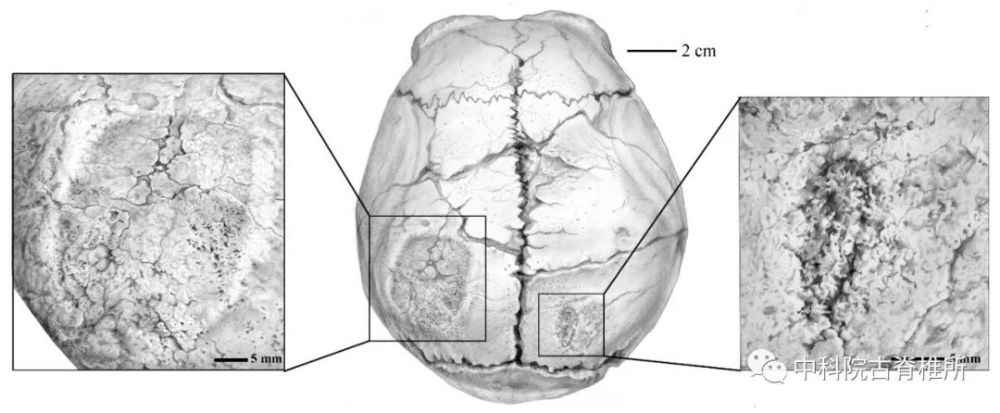 (图5):位于顶骨后部的矢状缝两侧,左侧痕迹近似四方形,长42.