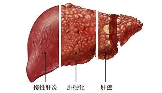 临床集锦丨干细胞治疗肝硬化安全有效