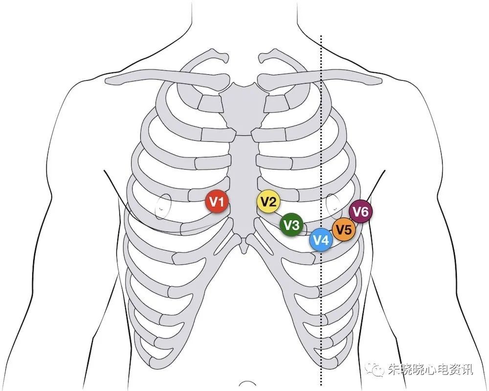 limb leads)包括标准肢体导联 i,ii,iii及加压肢体导联avr,avl,avf