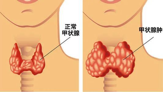 了解四大诱因,预防甲亢发作!