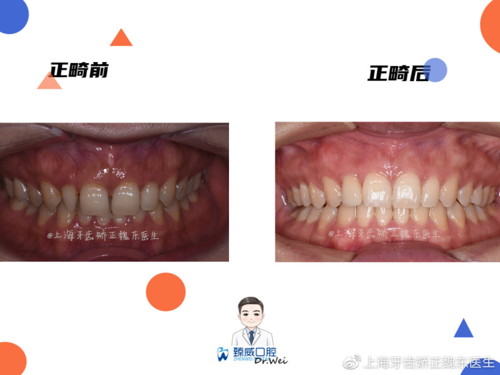 上海牙齿矫正魏东医生|深覆合和深覆盖是同种牙合吗?又有哪些危害呢?