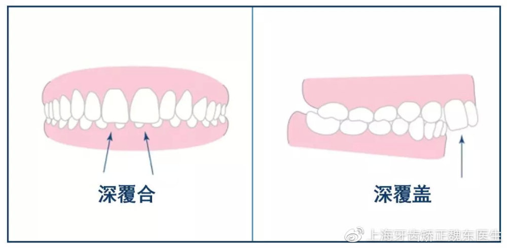 深覆合为上前牙切缘盖过下前牙牙冠长度1/3以上,是上下的关系.