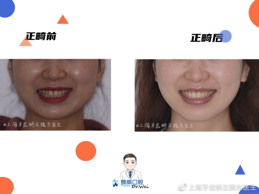 上海牙齿矫正魏东医生|深覆合和深覆盖是同种牙合吗?又有哪些危害呢?