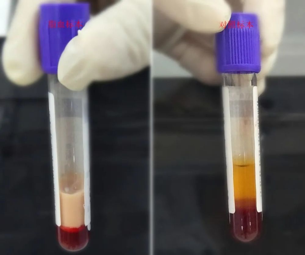 上表现为空泡的表现,难道是脂肪颗粒,为了印证我的想法,我把标本离心