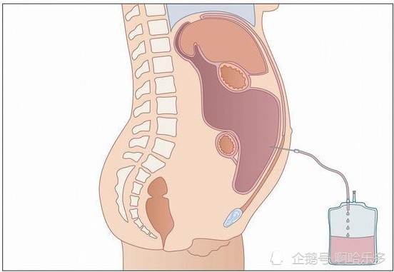 唐跃良 肝腹水有哪些治疗方法?