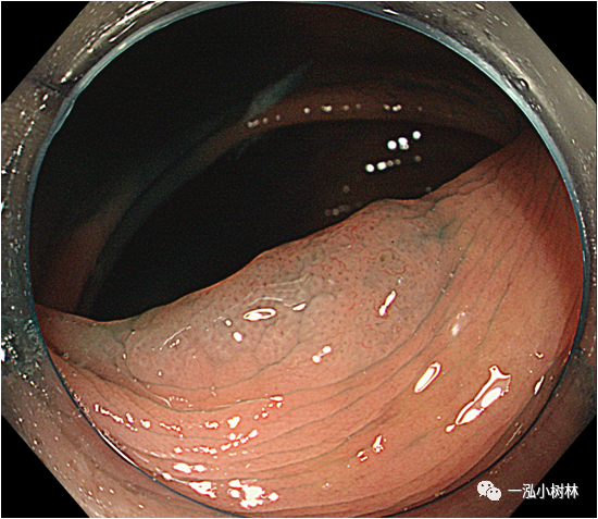 病例分享|锯齿状息肉与无蒂锯齿状息肉内镜与病理