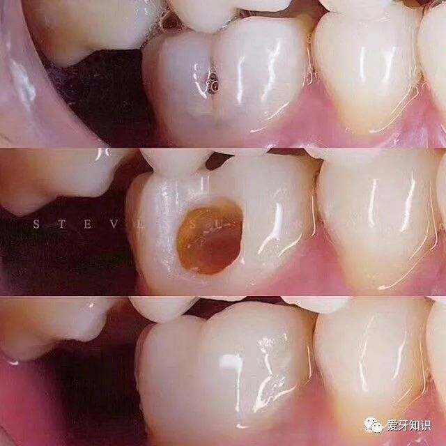为什么牙齿表面只有一个小洞,却需要治疗牙神经?