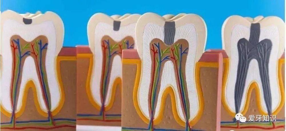 为什么牙齿表面只有一个小洞却需要治疗牙神经