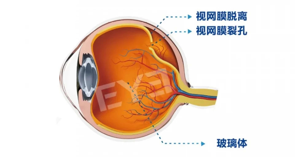 高度近视为什么会视网膜脱离?