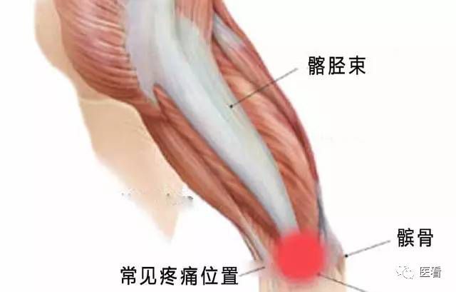 髂胫束解剖示意图,红色区域为髂胫束摩擦综合症常见疼痛部位