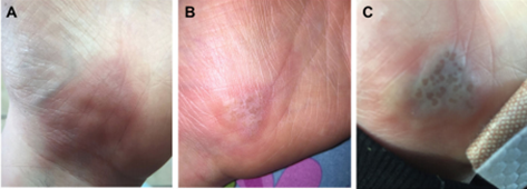 手掌疱疹性瘭疽,a-c为第1,3,4天的皮损变化(引自参考文献)皮损可围绕