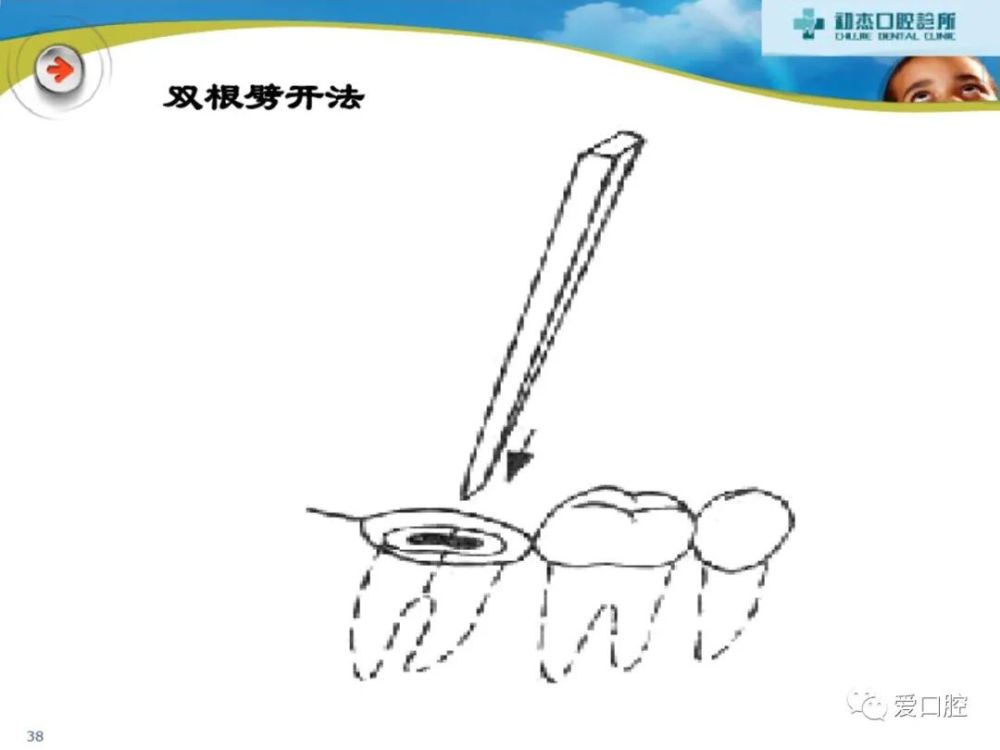 拔牙技术一般牙及残根拔除术干槽症的治疗方法牙挺的种类和使用方法