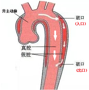 主动脉夹层常见问题