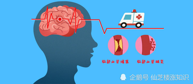 《脑卒中的预防与治疗》 专家:抢救紧抓黄金6小时!