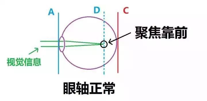 大部分是因为眼轴过长,进入的视觉信息聚焦位置不变,而视网膜却往后退