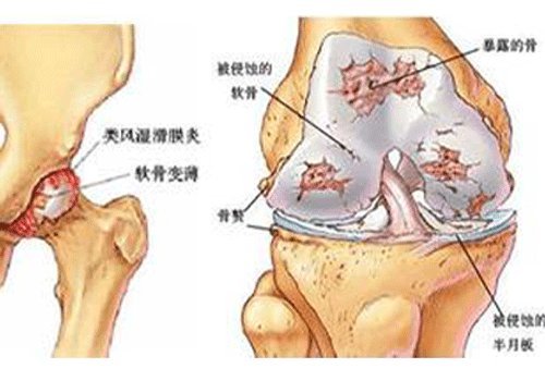 请鉴别诊断滑膜炎和半月板损伤