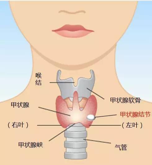 我为什么会得甲状腺癌