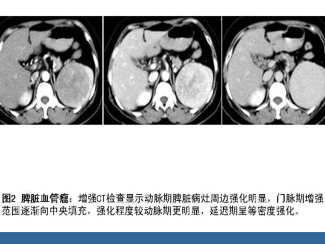 脾脏肿瘤ct诊断