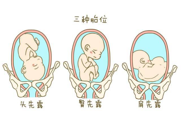 臀位和横位都属于异常胎位,尤其是横位,会导致梗阻性难产,子宫破裂等