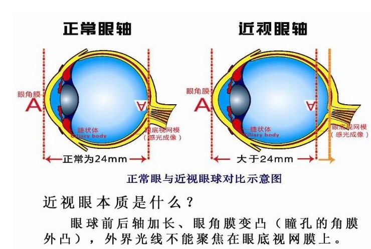 怎么让近视的眼睛恢复正常(不近视)?