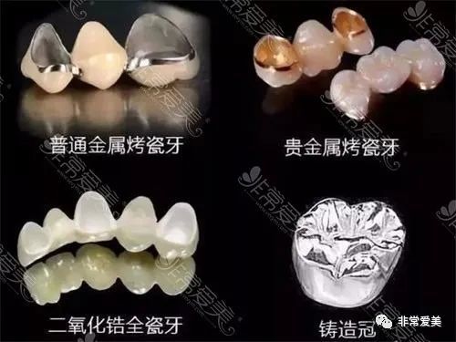 详细畅谈:种植牙材质分几种类型?纯钛>全瓷>贵金属!
