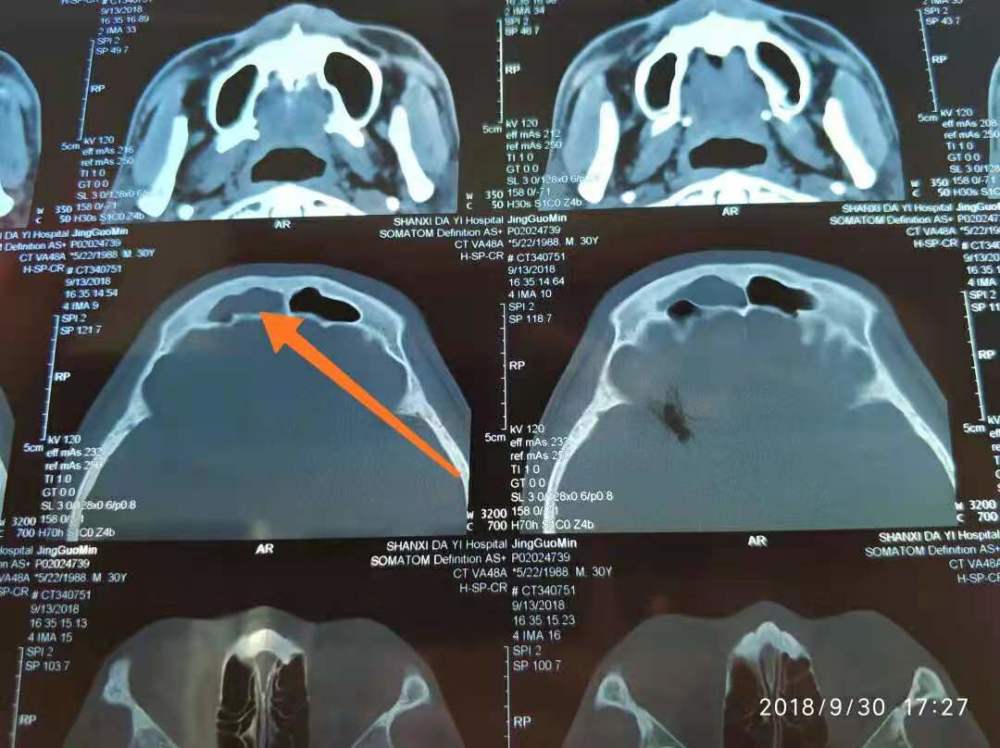 耳鼻喉科申力主任说,鼻窦炎手术主要是切除堵塞鼻腔的病变,比如切除