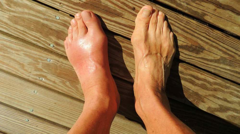 痛风通常一次只发生在一个关节,最常见是出现在大脚趾.