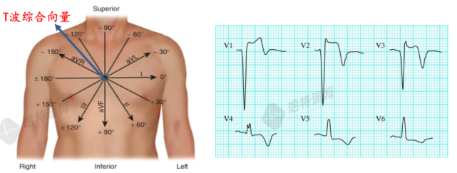 最全t波倒置的鉴别诊断思路都在这!