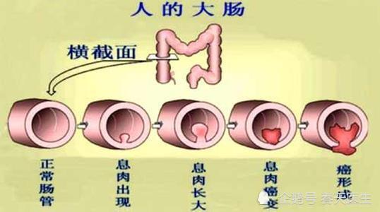 四,罹患大肠癌有一定会死吗?目前有多少存活率?