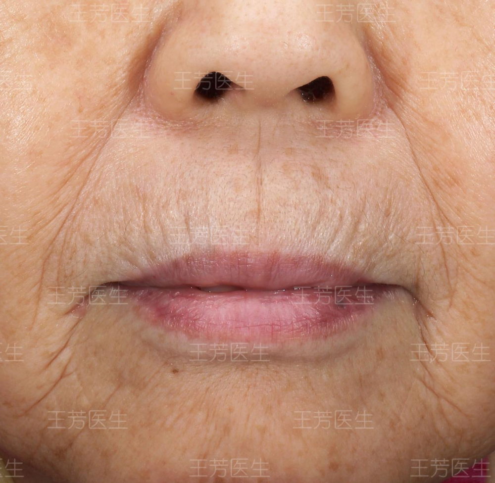 吹火纹或称"吸烟纹",是嘴唇周围的纵形皱纹,也是口周皮肤老化,弹性