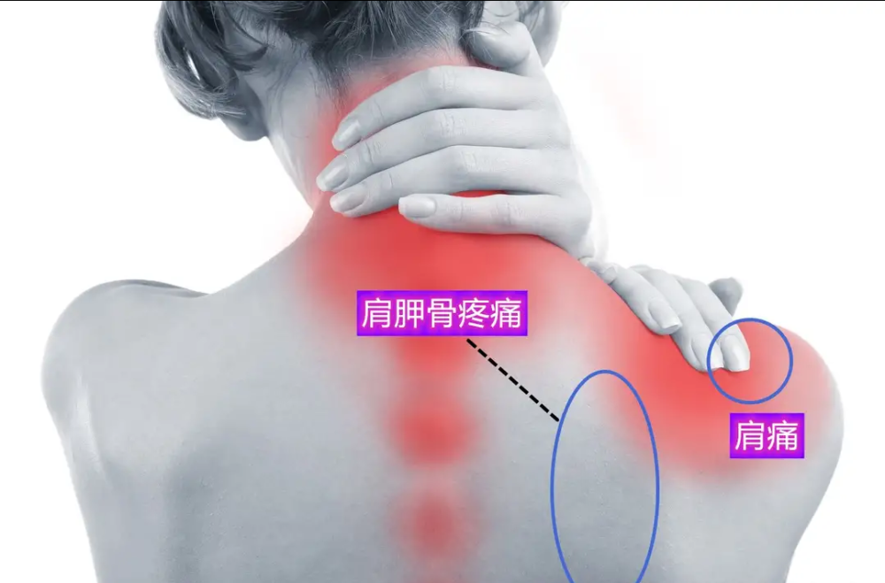 骨科医生教你,自测肩膀痛代表什么问题?