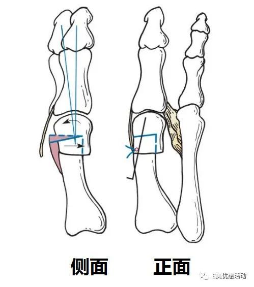 宋茜左脚大拇指被挤得通红,右脚更是明显变形,严重的外翻