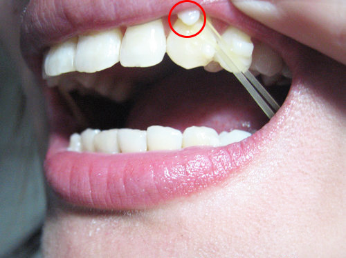 如果是隐形矫正的过程中需要佩戴橡皮筋,医生会在牙齿上面黏"舌侧扣"