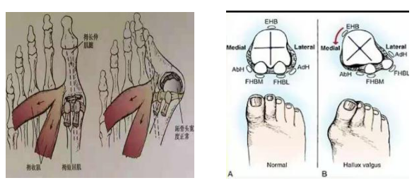 第一跖骨内收,第一,二跖骨间角增大合并第一跖骨头内侧骨赘增生和踇囊
