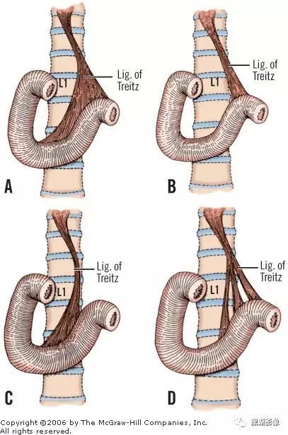 treitz韧带怎么也看不见的屈氏韧带