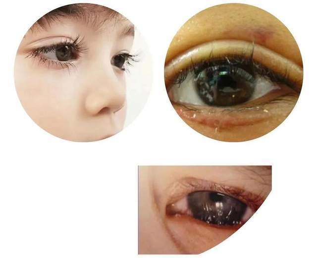 台宝诊所小课堂|宝宝频繁眨眼,流眼泪?可能是倒睫在作祟